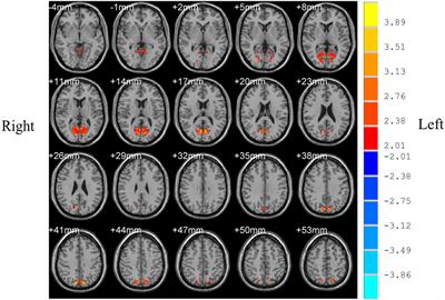 Aberrant Interhemispheric Connectivity in Obstructive Sleep Apnea–Hypopnea Syndrome